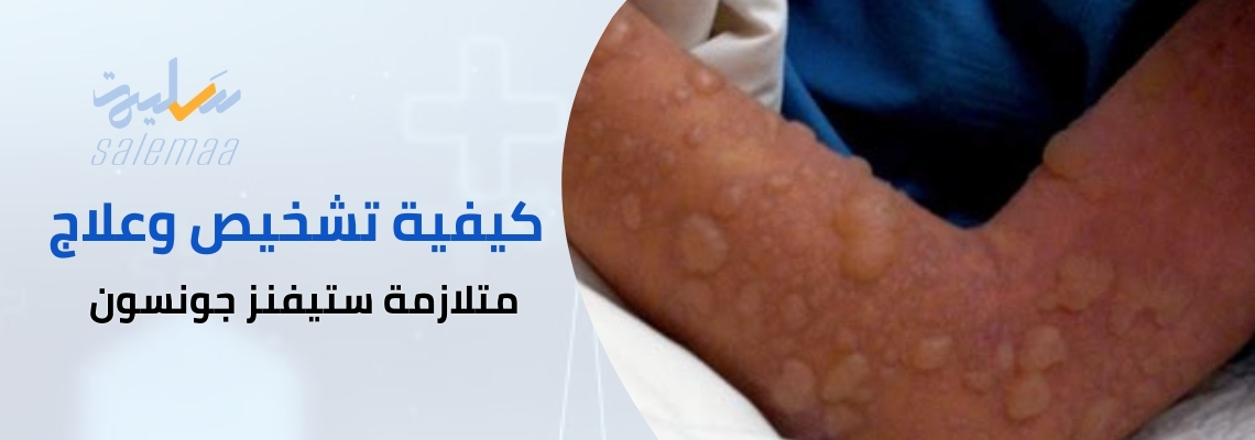 كيفية تشخيص وعلاج متلازمة ستيفنز جونسون