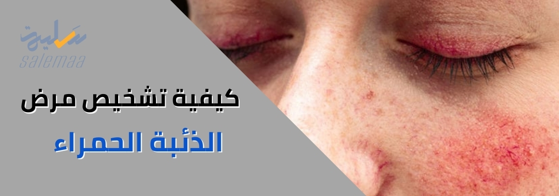 كيفية تشخيص مرض الذئبة الحمراء