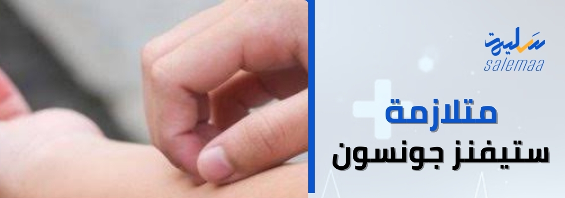 كل ما تحتاج لمعرفته عن متلازمة ستيفنز جونسون: أسباب، أعراض، وعلاجات فعّالة!