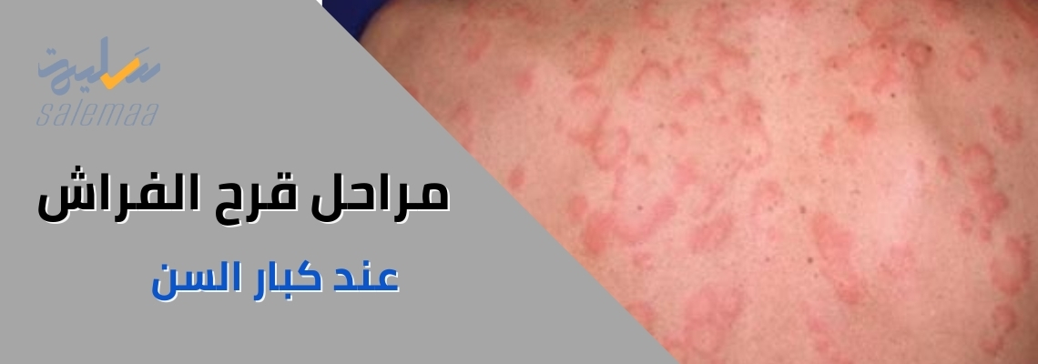 مراحل قرح الفراش عند كبار السن