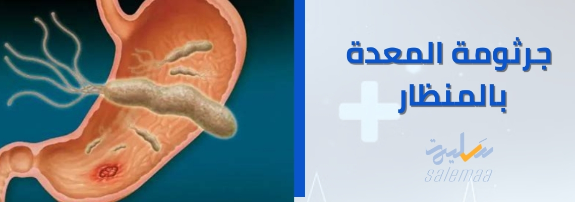 جرثومة المعدة بالمنظار