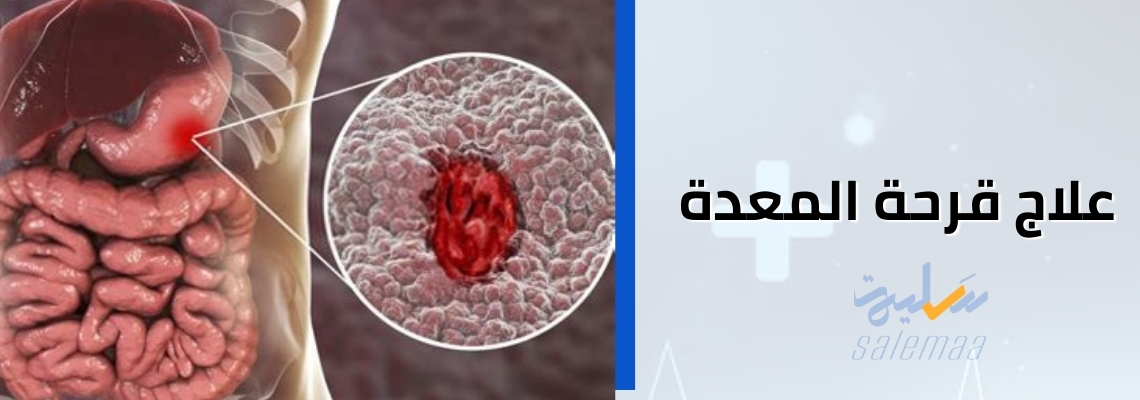 علاج قرحة المعدة