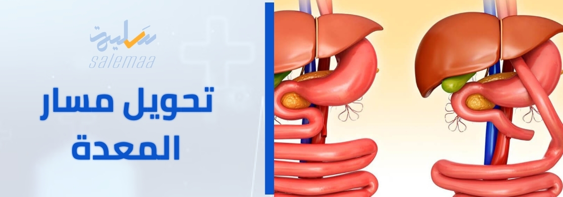 جراحة تحويل مسار المعدة