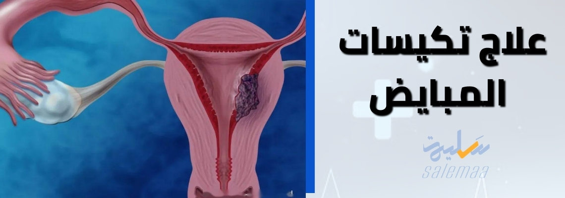 علاج تكيس المبايض