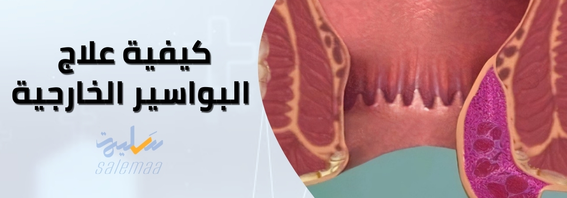 كيفية علاج البواسير الخارجية